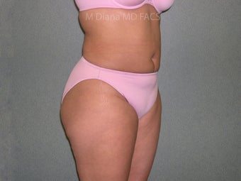 SmartLipo after 607523