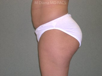SmartLipo 607523