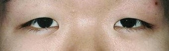 Bilateral Asian Eyelid Surgery before 861047
