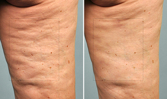 Cellulaze before 996936
