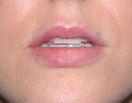 Injectables after 112080