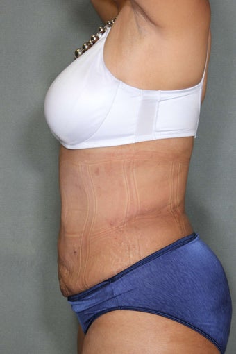 51 Year Old Female Treated for UnWanted Fat With SmartLipo and Vaser Laser after 839642