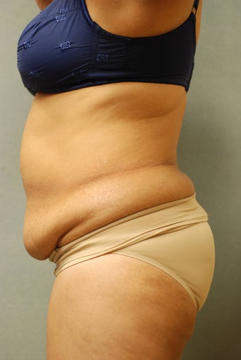 51 Year Old Female Treated for UnWanted Fat With SmartLipo and Vaser Laser before 839642