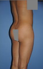Fat Transfer 504989