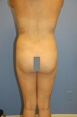 Fat Transfer before 504989