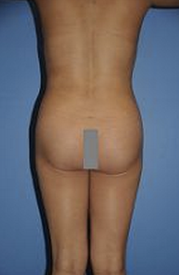 Fat Transfer after 504989