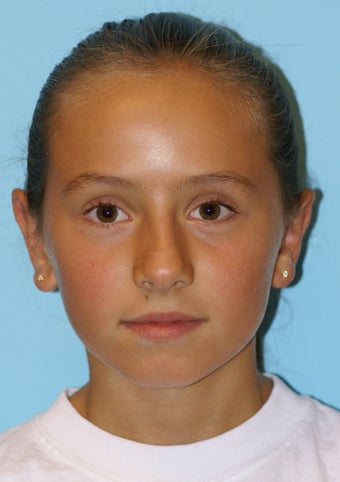 Otoplasty after 581168