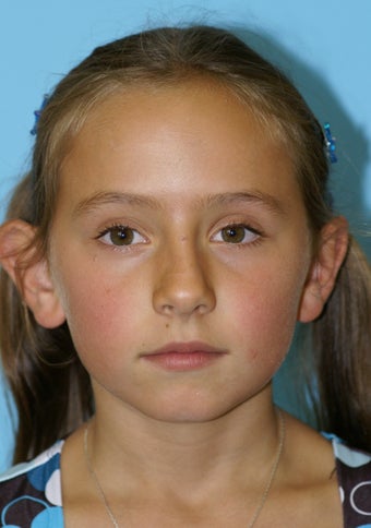 Otoplasty before 581168