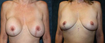 Removal of Breast Implants - Replaced with Stem Cell Enhanced Fat - Breast Scar Revision before 1334650