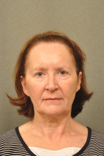 66 year old female treated for sun damage and wrinkles before 927780