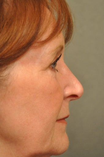 66 year old female treated for sun damage and wrinkles 927780