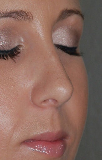 Rhinoplasty - Refine tip, Widen Dorsum after 134440