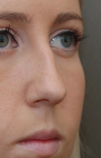 Rhinoplasty - Refine tip, Widen Dorsum before 134440