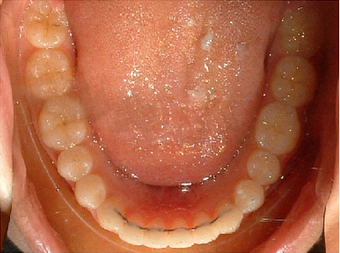Invisalign treatment for spaced out teeth 881799
