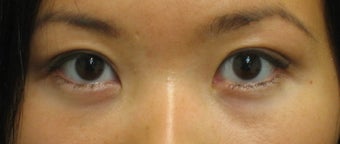Double eyelid surgery with CO2 laser after 259536
