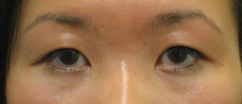 Double eyelid surgery with CO2 laser before 259536