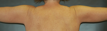 Brachioplasty after 529915