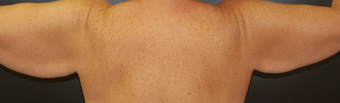 Brachioplasty before 529915