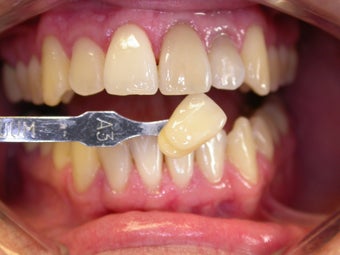 45 year old male patient - cosmetic veneers before 841212
