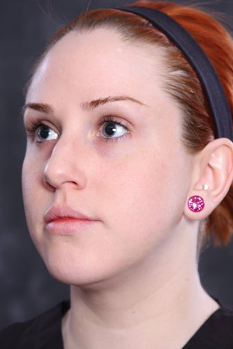 Photofacial after 1140555