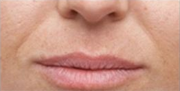 Restylane before 987607