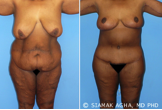 Body Lift before 216784