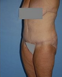Body Lift 296706