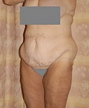 Body Lift 296706