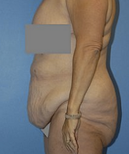 Body Lift before 296706