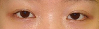 Revision Bilateral Asian Eyelid Surgery before 861210