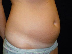 Mini Tummy Tuck 466963