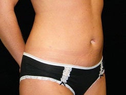 Mini Tummy Tuck 466963