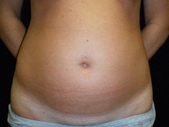 Mini Tummy Tuck before 466963