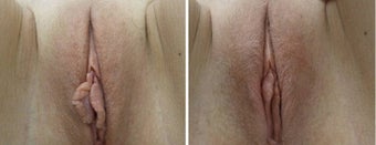 Labiaplasty before 665723