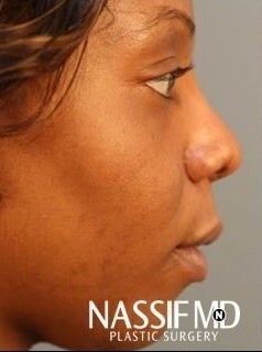 African American Female Rhinoplasty 960131
