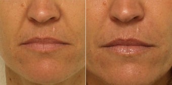 Smile lines treated with Restylane before 653399