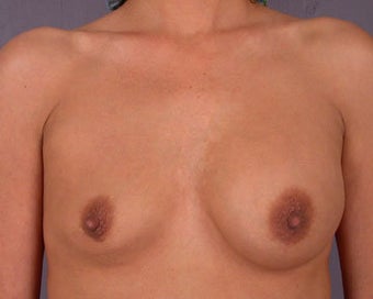 Breast Implant Correction before 281304