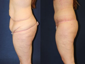 29 year old woman treated for excess skin following weight loss before 1251779