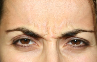 Botox in the Glabella before 1168428