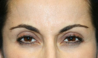 Botox in the Glabella after 1168428