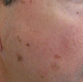 58 year old Male with undesired Pigmentation on face before 694161