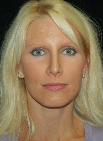 Revision Rhinoplasty after 392827