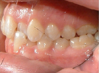 Invisalign 890215