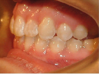 Invisalign 890215