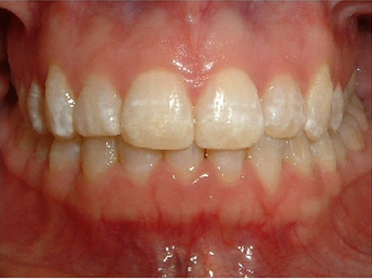 Invisalign after 890215
