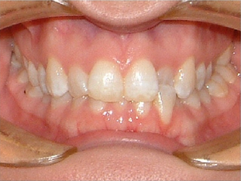Invisalign before 890215