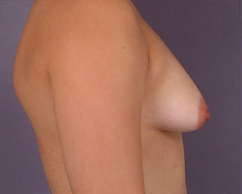 Breast Asymmetry Correction before 281321