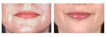 Lip Augmentation with Fat injection before 6434