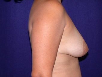 Breast Augmentation before 205564