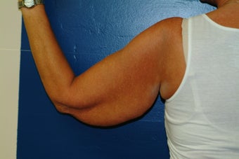 Brachioplasty 575815